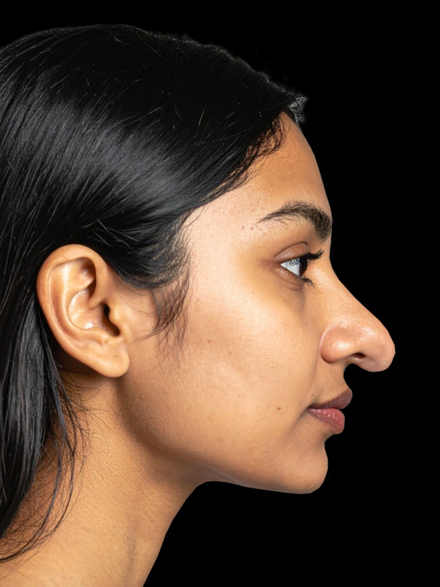 Przed - Korekta nosa